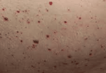 tiny bloody spots on skin