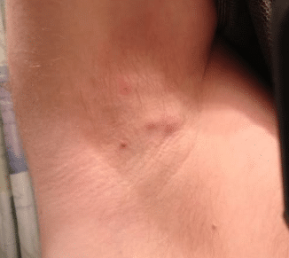 bump under armpit