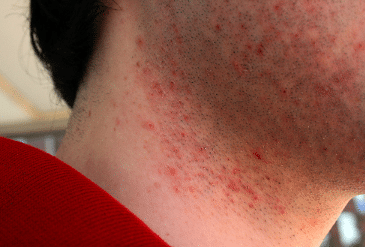 how to get rid of shaving bumps on neck