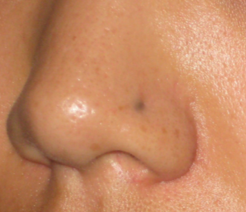 scarring nose piercing