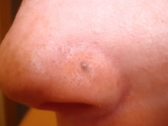 nose piercing scar