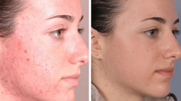Chemical peel to get rid of acne scars