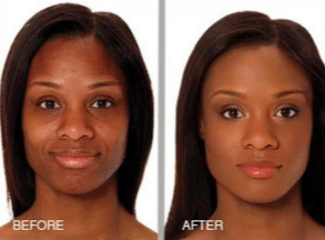 Best chemical peel for acne scars and dark skin