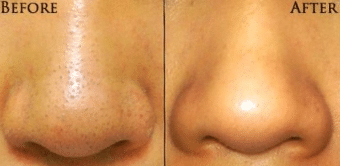 Home remedies for clogged pores on nose