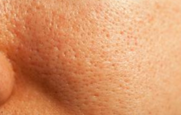 Large pores on face causes