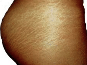 How to fade away stretch marks on buttocks