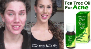 Tea tree oil to get rid of acne scars