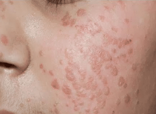 Warts on face causes