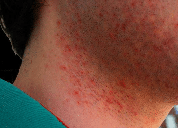 Red bumps after shaving face