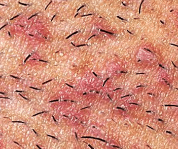 Red bumps after shaving pubes 
