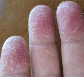 Cracked skin on fingers causes