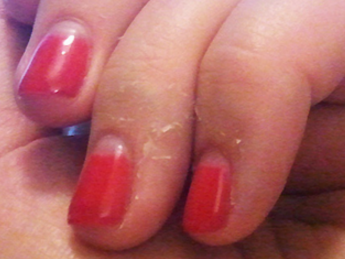 Cracked finger nail skin causes