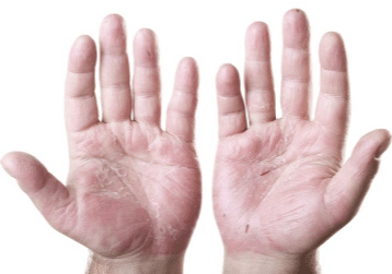 Dry cracked hands causes