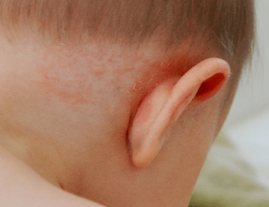 Dry skin behind ears baby