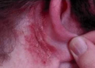 Causes of dry skin behind ears