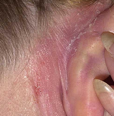 Dry skin behind ears causes