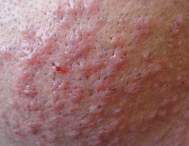 Itchy skin after shaving causes