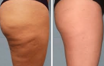 How to remove cellulite on thighs and bum