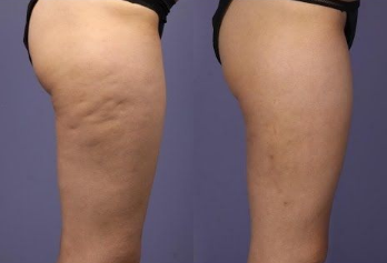 How to remove cellulite on thighs and bum
