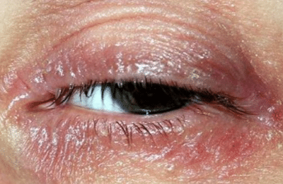 Dry skin on eyelid causes