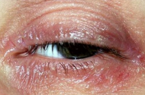 dry itchy eyelids treatment