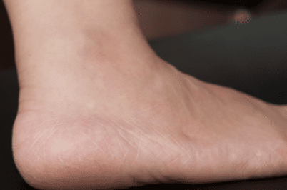 Dry skin on feet causes
